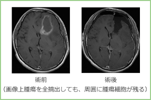 脳腫瘍