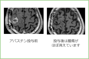 脳腫瘍