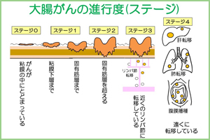 大腸がん